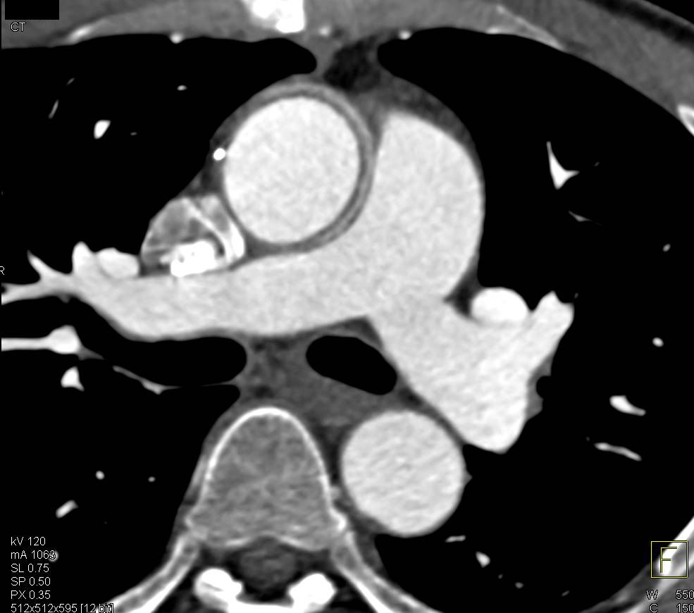 Aortic Root Repair in Marfan's Patient with Dilated Origin of Reimplanted Right Coronary Artery (RCA) - CTisus CT Scan