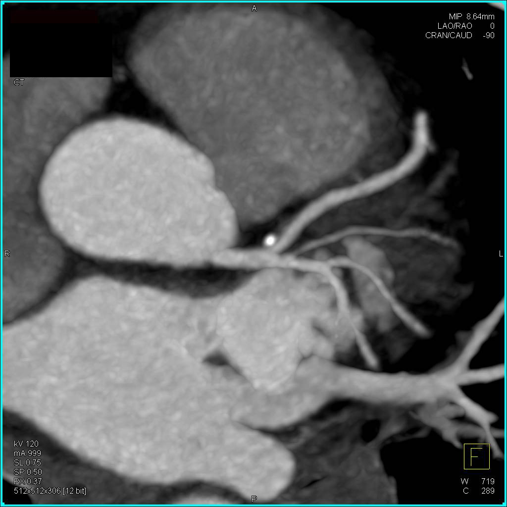 CCTA: Left Anterior Descending Coronary Artery (LAD) Mixed Plaque - CTisus CT Scan