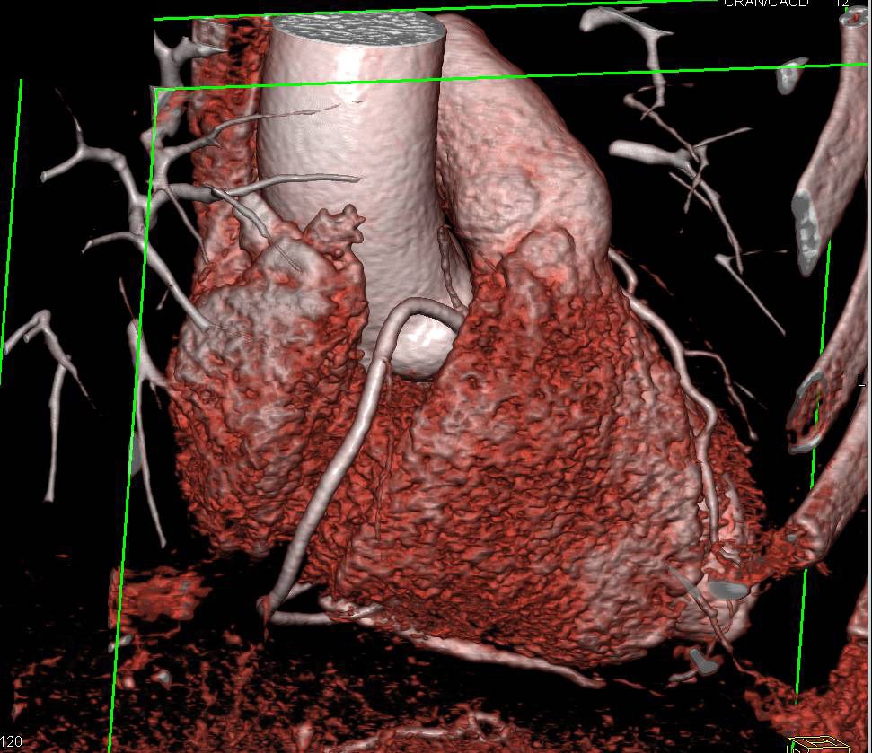 CCTA: Minimal Plaque with 3D Mapping - CTisus CT Scan