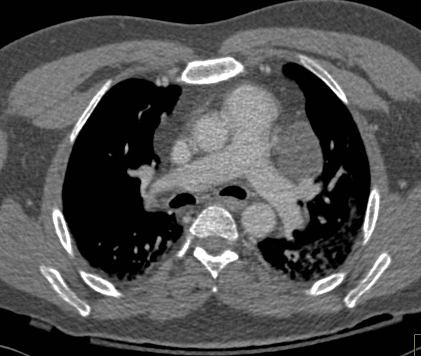 Pericardial Cyst - CTisus CT Scan