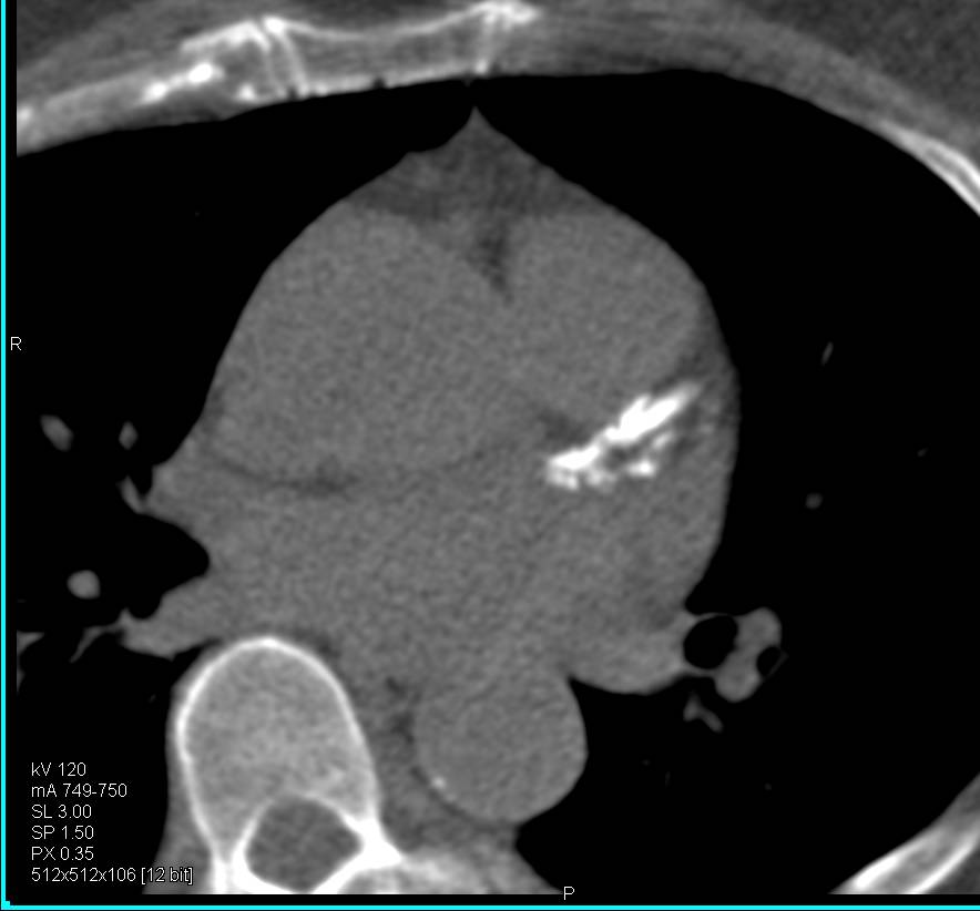 CCTA: Multivessel Disease with Extensive Left Anterior Descending Coronary Artery (LAD) Plaque and Greater Than 50% Stenosis - CTisus CT Scan