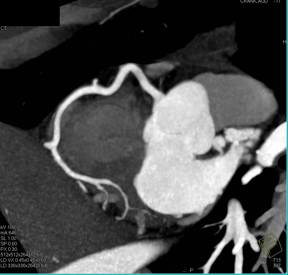 CCTA: Normal Right Coronary Artery (RCA) in Multiple Phases Showing the Effect of RCA Motion which is up to 4 cm - CTisus CT Scan