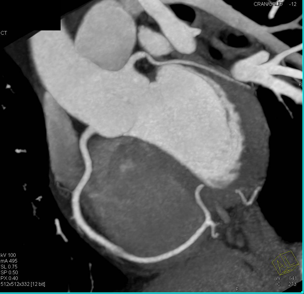 CCTA: Normal Coronary Artery Study with Various Displays - CTisus CT Scan