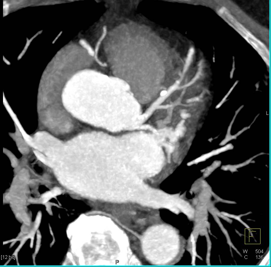 CCTA: Multivessel Disease with Mixed Plaque - CTisus CT Scan