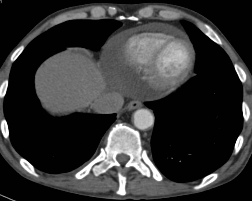 Pericardial Effusion and Peritoneal Inflammation - CTisus CT Scan