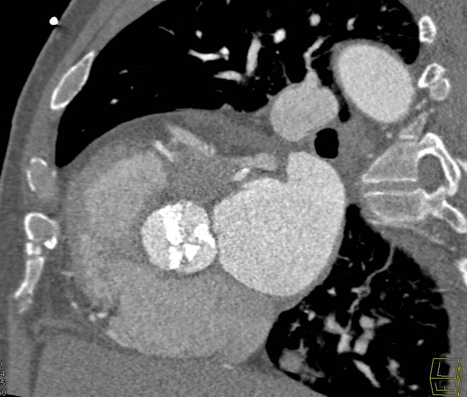 Extensive Aortic Valve Calcification With Aortic Stenosis And Dilated