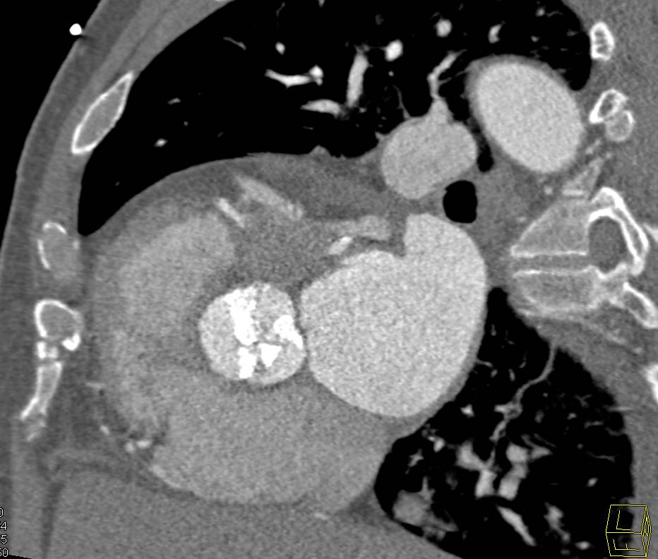 Extensive Aortic Valve Calcification with Aortic Stenosis and Dilated Ascending Aorta - CTisus CT Scan