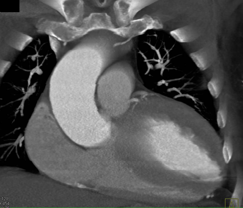 aortic stenosis death spiral