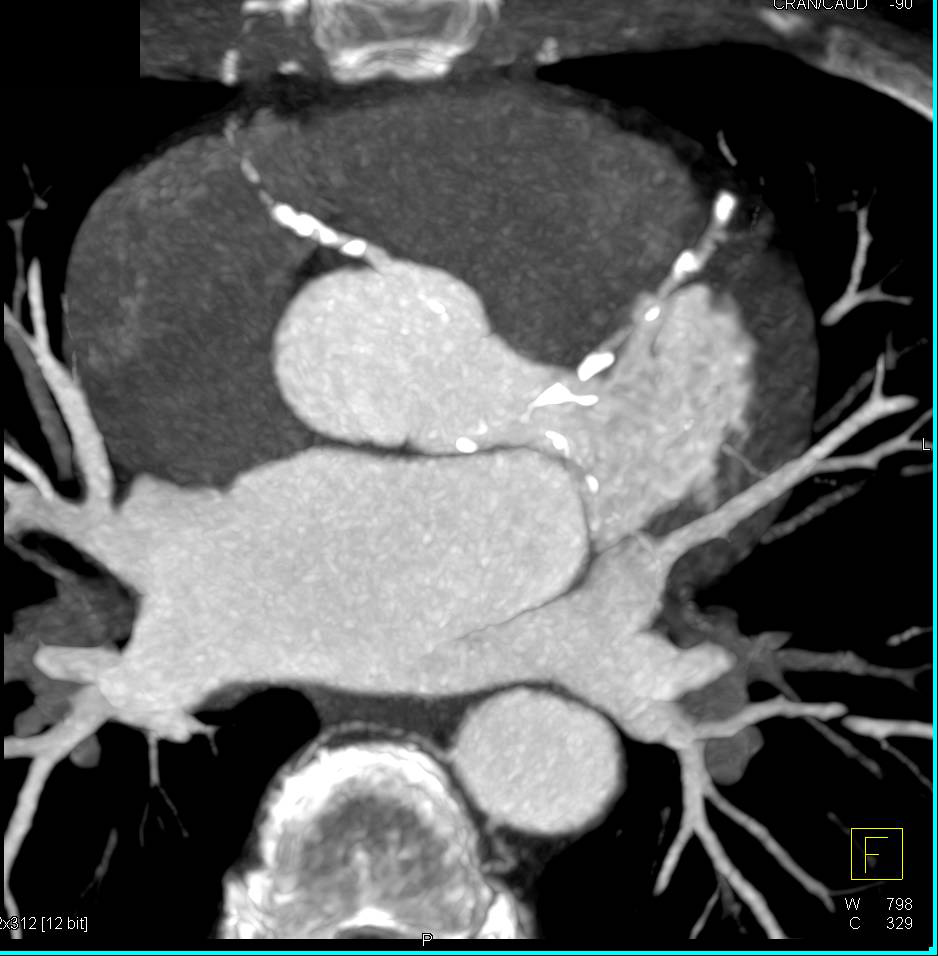 CCTA: Markedly Elevated Calcium Score with Multiple Calcified Plaques as well as Noncalcified Plaques with 3 Vessel Disease - CTisus CT Scan