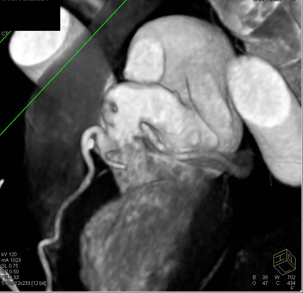 CCTA: Plaque with Evidence of Coronary Artery Disease - CTisus CT Scan