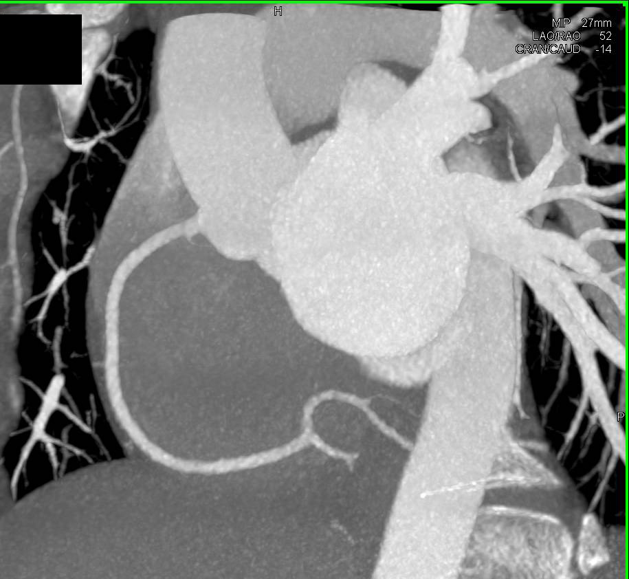 CCTA: Normal Cardiac CTA - CTisus CT Scan