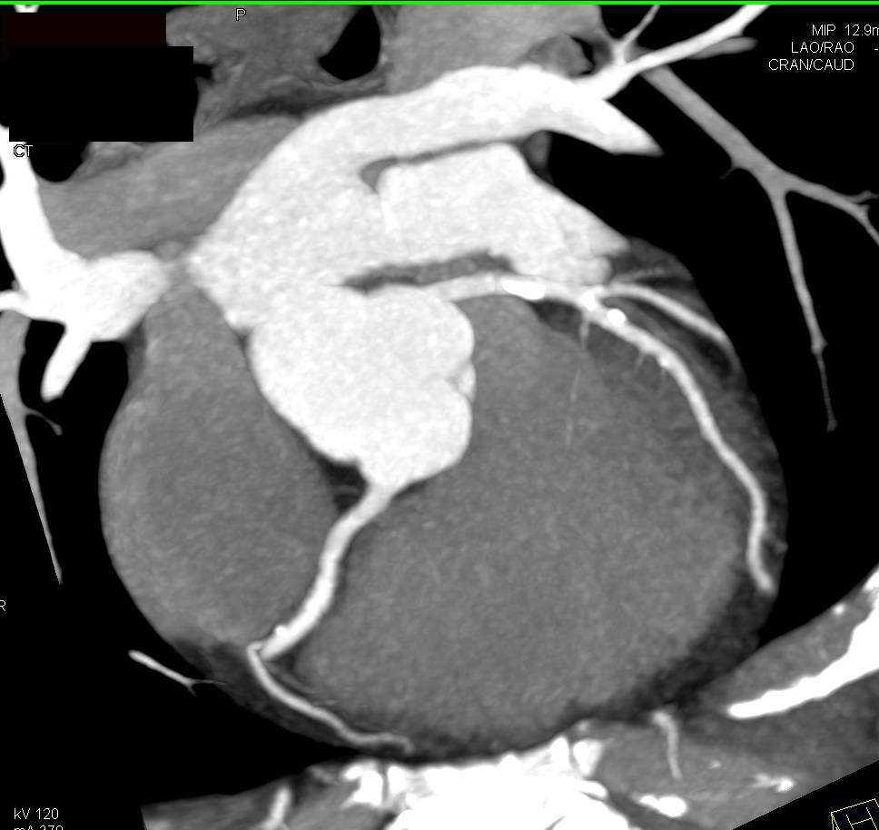 CCTA: Calcified Plaque Best Seen in Left Anterior Descending Coronary Artery (LAD) - CTisus CT Scan