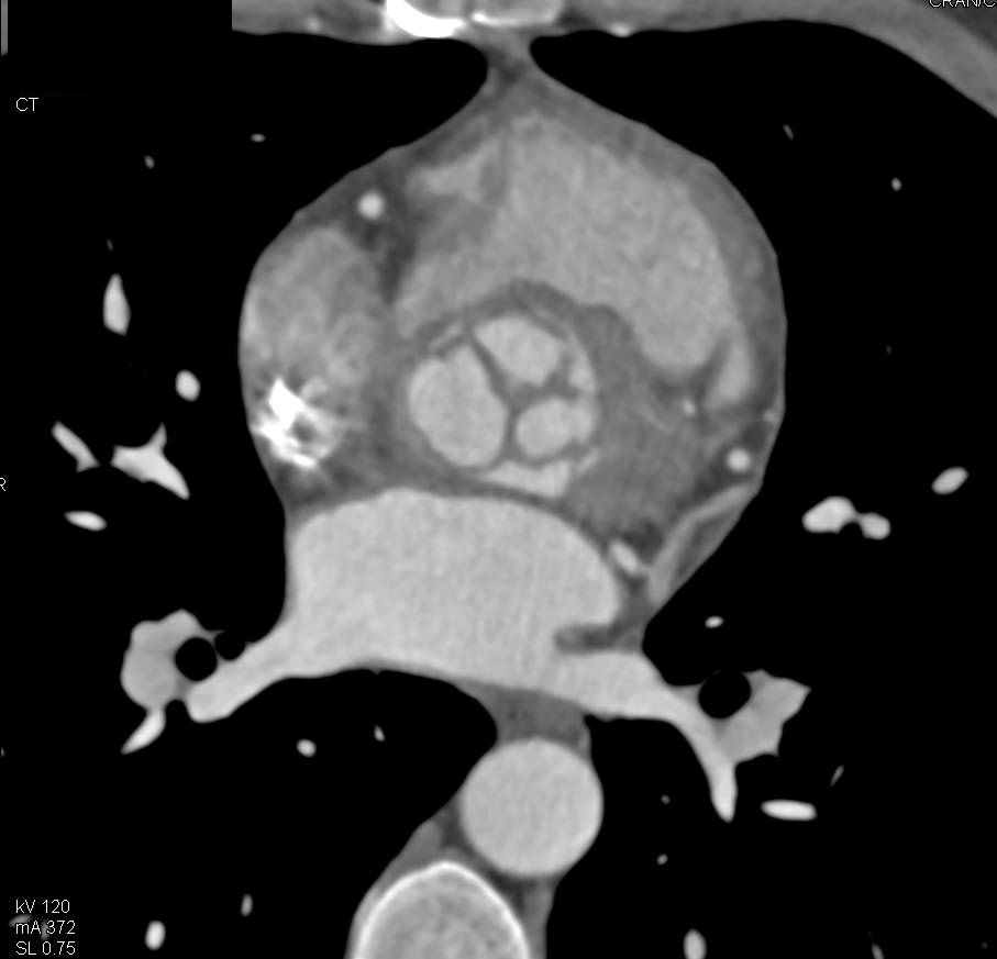 Thickened Aortic Valve Leaflets with Dilated Ascending Aorta - CTisus CT Scan