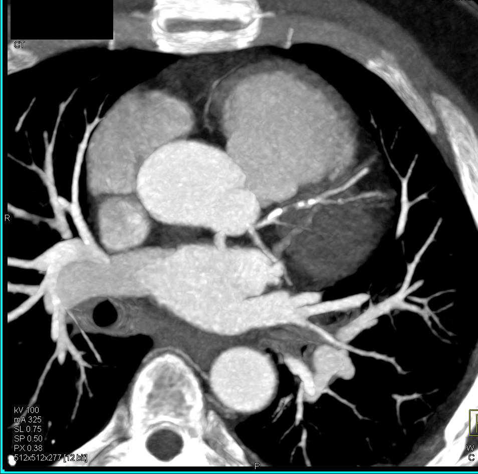 CCTA: Critical Left Anterior Descending Coronary Artery (LAD) Stenosis in 70% Range with Mixed Plaque Seen - CTisus CT Scan