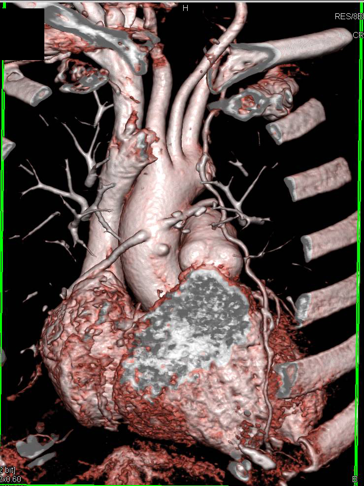 CCTA Defines 3 Venous Grafts off the Ascending Aorta (one of which is occluded) and a LIMA Graft - CTisus CT Scan