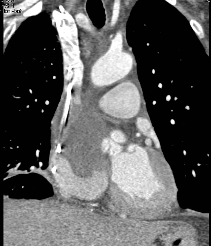 Angiosarcoma Invades the Right Cardiac Chambers - CTisus CT Scan