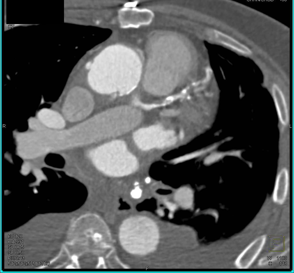 CCTA: Left Internal Mammary Artery (LIMA) as well as Venous Coronary Artery Bypass Graft (CABG) in Patient with Occluded Left Coronary Artery - CTisus CT Scan