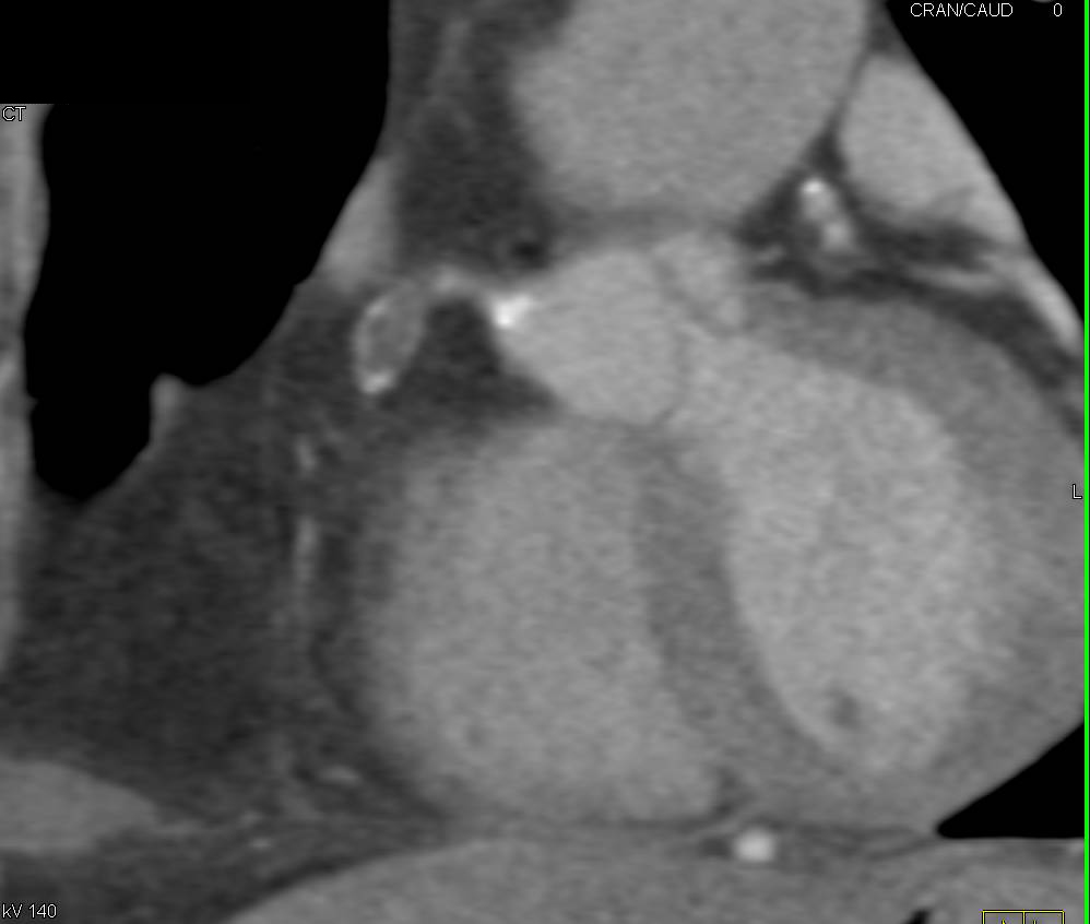 Right Coronary Artery (RCA) Aneurysm with Occlusion - CTisus CT Scan