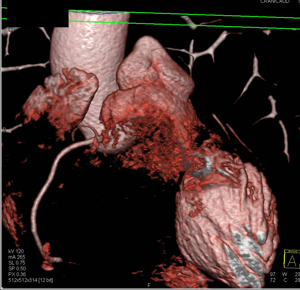 CCTA with Pre-Operative Planning for Aortic Valve Replacement in a Patient with Extensive Valve Calcification. Note Details of Coronary Artery Anatomy Provided. - CTisus CT Scan