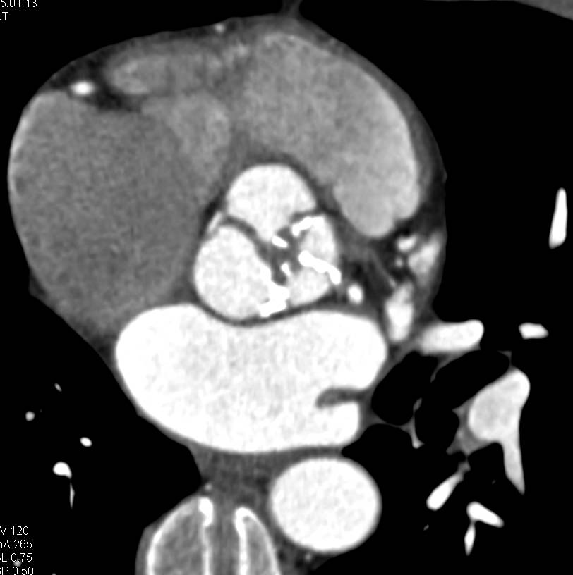 ccta-with-pre-operative-planning-for-aortic-valve-replacement-in-a