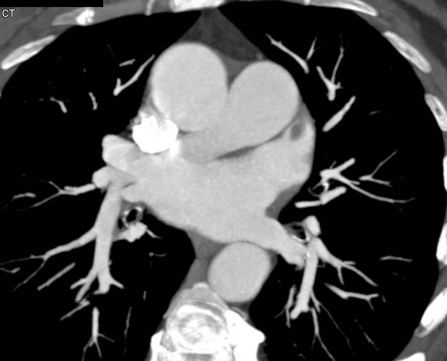 Excellent Example of Thrombus in the Left Atrial Appendage and a Renal Infarct as its Sequelae - CTisus CT Scan