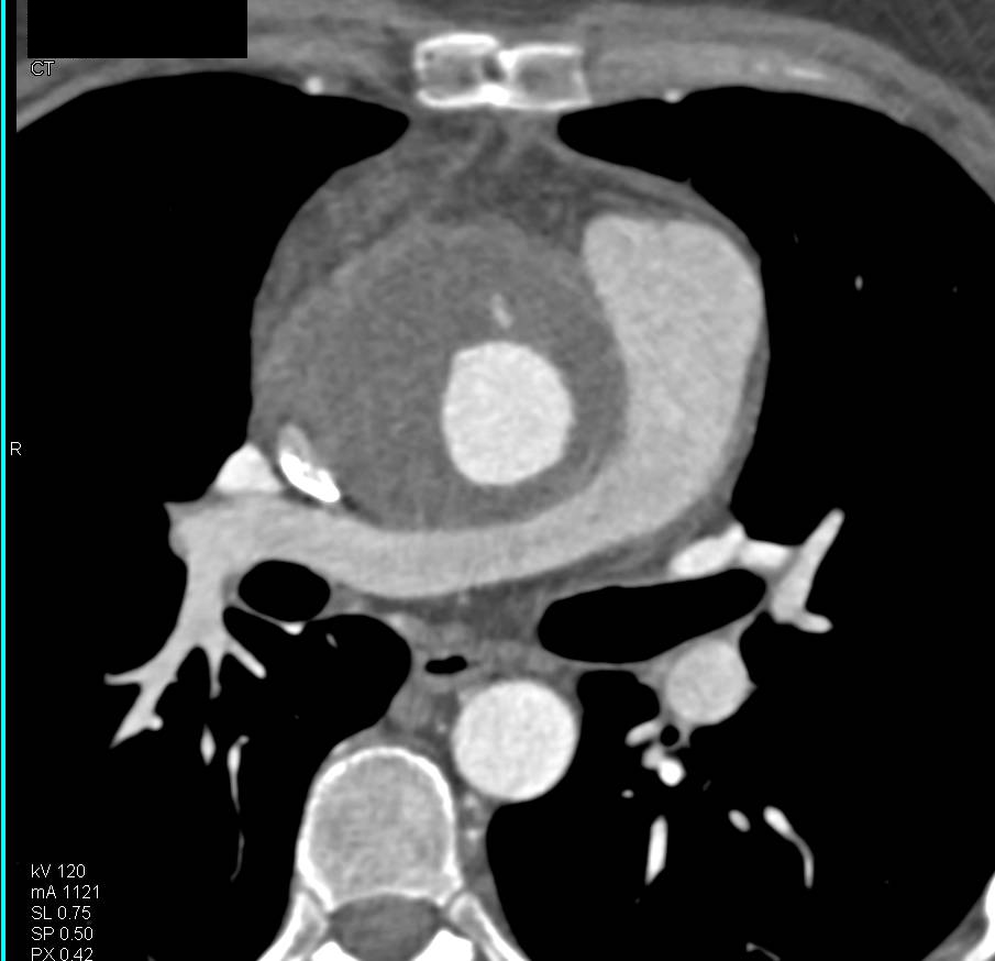 Ascending Aortic Aneurysm Repair with Graft Shown in 3D - CTisus CT Scan