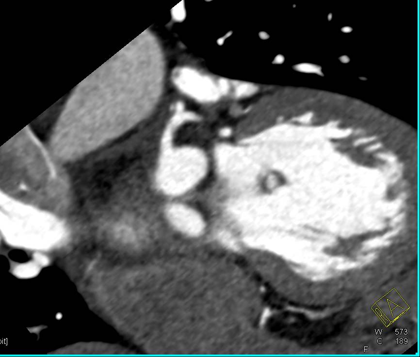 CCTA: Coronary Artery Disease with Mixed Plaque - CTisus CT Scan