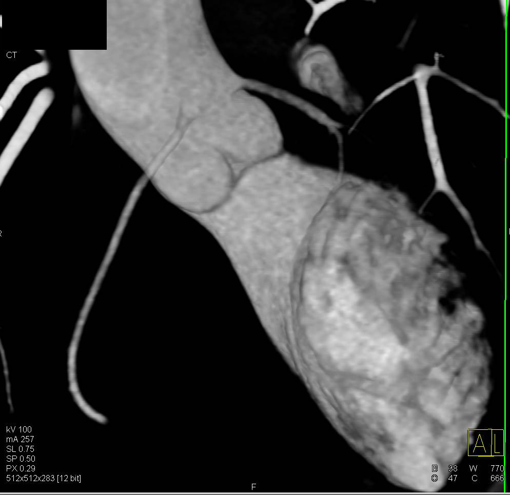 CCTA: High Origins of Both the Right and Left Coronary Arteries off the Left Cusp - CTisus CT Scan