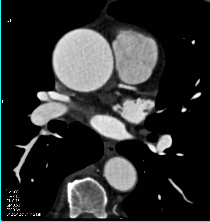 Aortic Valve Calcification with Aortic Stenosis and Dilated Ascending Aorta. Coronary Artery Disease Also Seen - CTisus CT Scan