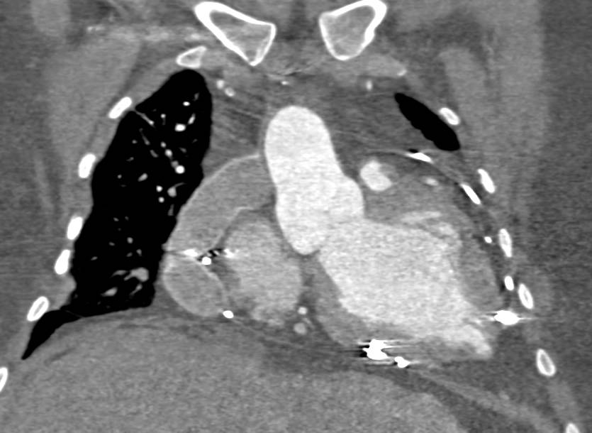 Venous Grafts do not Opacify on Early Phase Imaging and Can Simulate a Hilar Mass - CTisus CT Scan