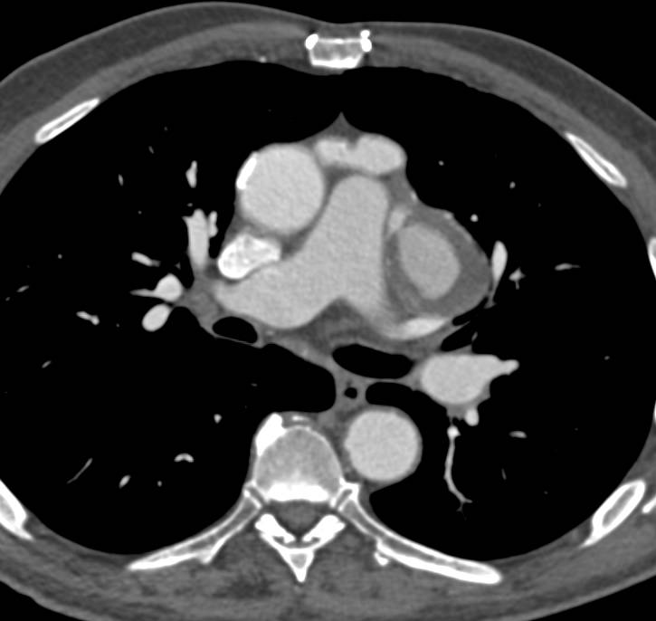 Aneurysm of a Venous Bypass Graft Simulated A Hilar Mass - CTisus CT Scan