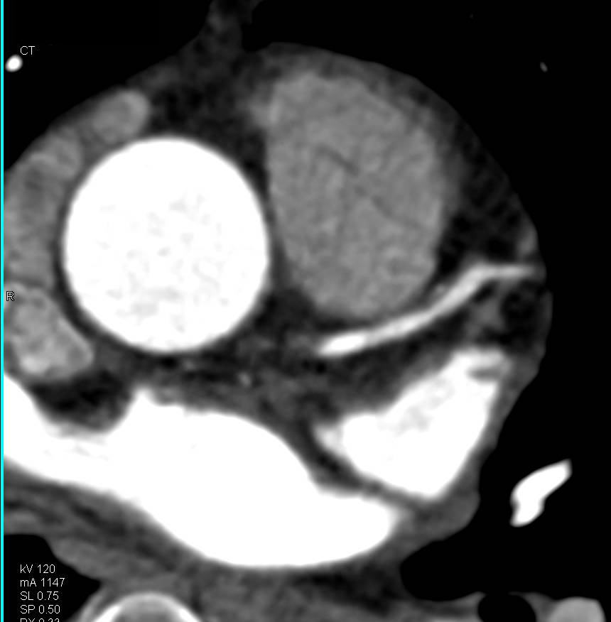 CCTA: Mixed Left Anterior Descending Coronary Artery (LAD) Plaque - CTisus CT Scan