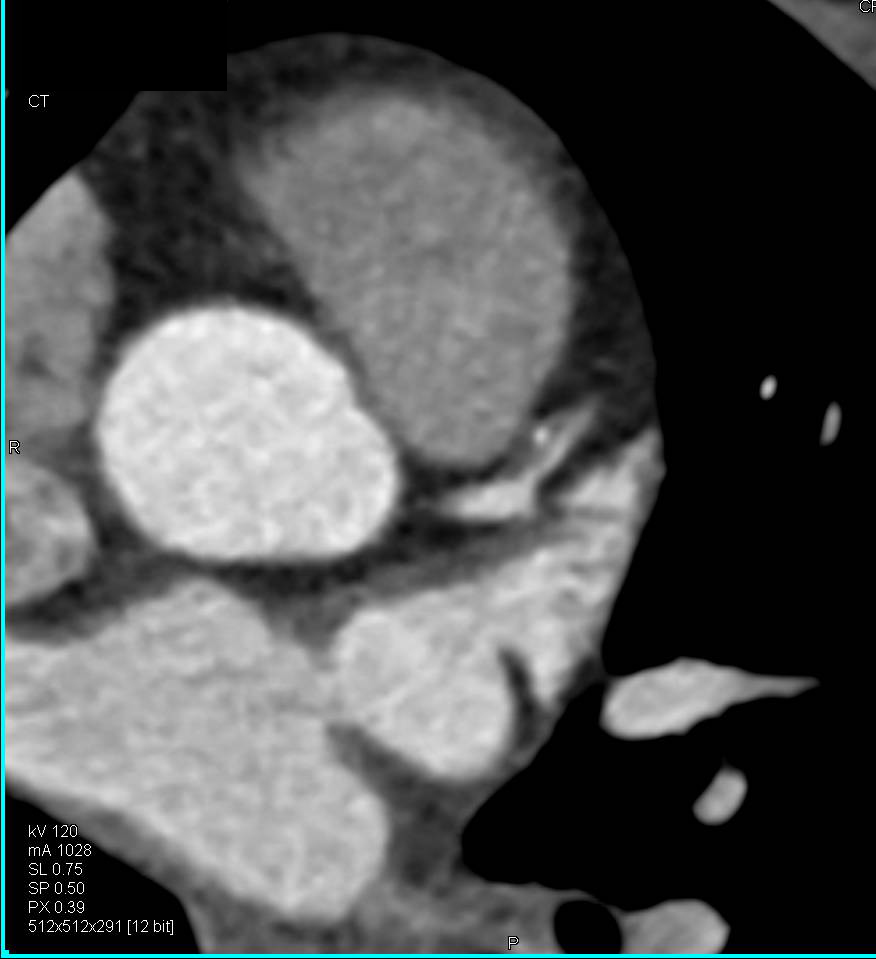 CCTA: Mixed Left Anterior Descending Coronary Artery (LAD) Plaque - CTisus CT Scan