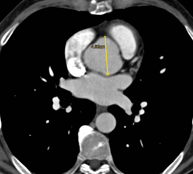 Dilated Sinus of Valsalva in a Patient with Marfan Syndrome - CTisus CT Scan