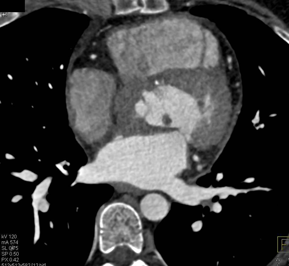 Aortic Root and Ascending Aorta Repair. Note the thrombus on Aortic Valve Leaflet. - CTisus CT Scan