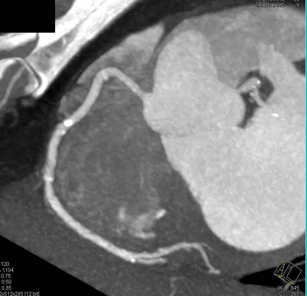 CCTA: Multivessel Coronary Artery with Greater than 50% Left Anterior Descending Coronary Artery (LAD) Stenosis - CTisus CT Scan