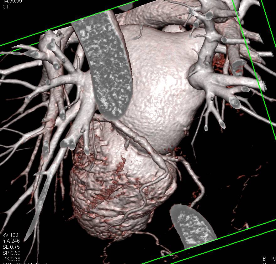 Pulmonary Veins for Pre-Ablation Evaluation - CTisus CT Scan