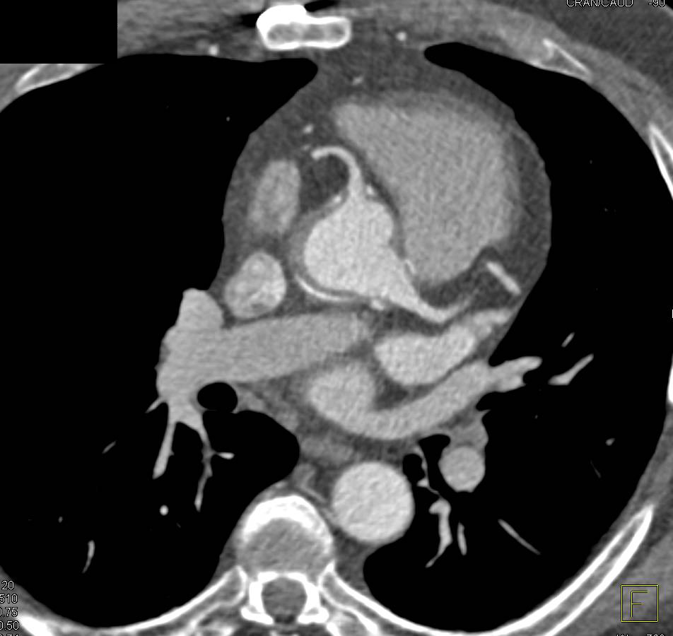 Aortic Root Repair with Reimplantation of the Coronary Arteries - CTisus CT Scan