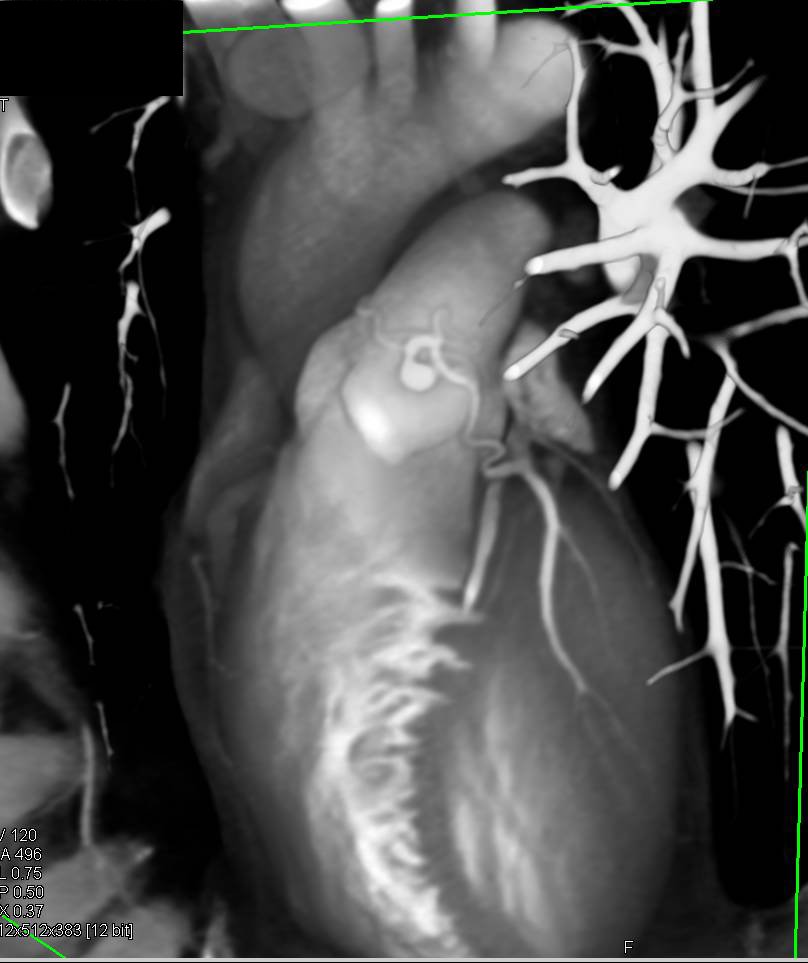 Incredible Vascular Shunt from Left Anterior Descending Artery (LAD) to the Right Outflow Track. Look at the Serpentine Appearance of the Vessels in Multiple Views - CTisus CT Scan