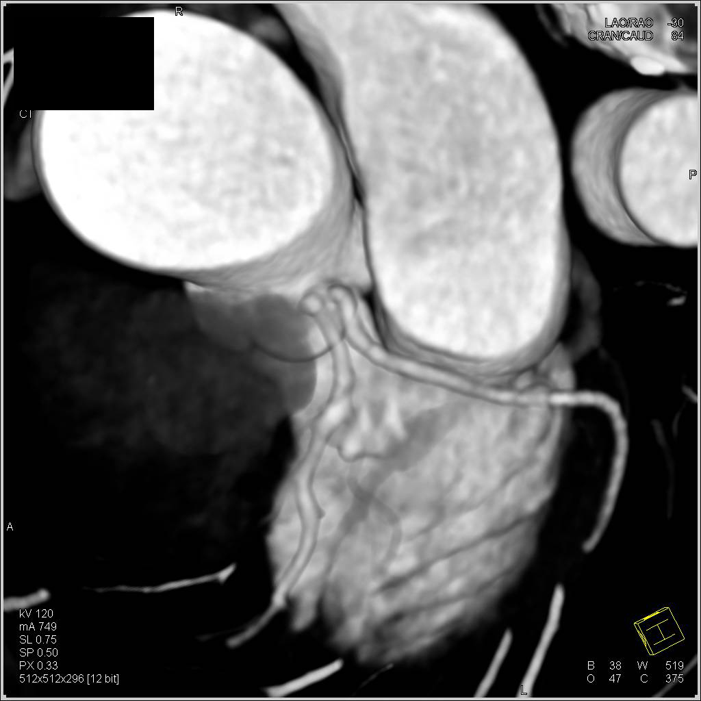 Bicuspid Aortic Valve as well as the Left Anterior Descending Coronary Artery (LAD) and Circumflex Artery (CX) Arise Separately off the Left Cusp - CTisus CT Scan