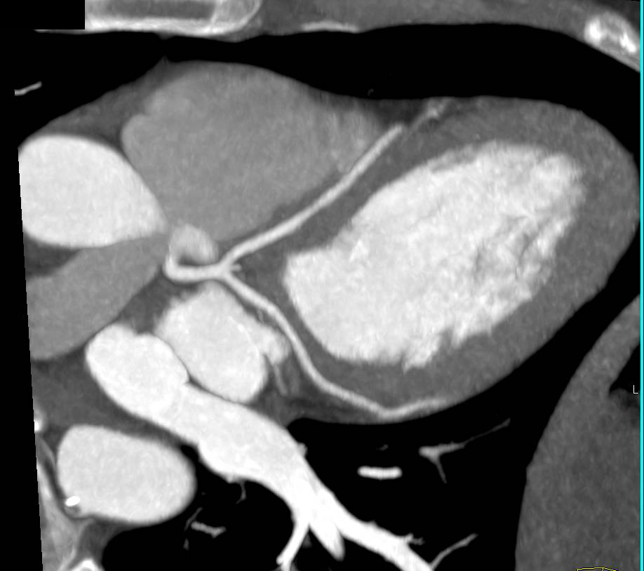 CCTA: Normal Coronary Anatomy - CTisus CT Scan