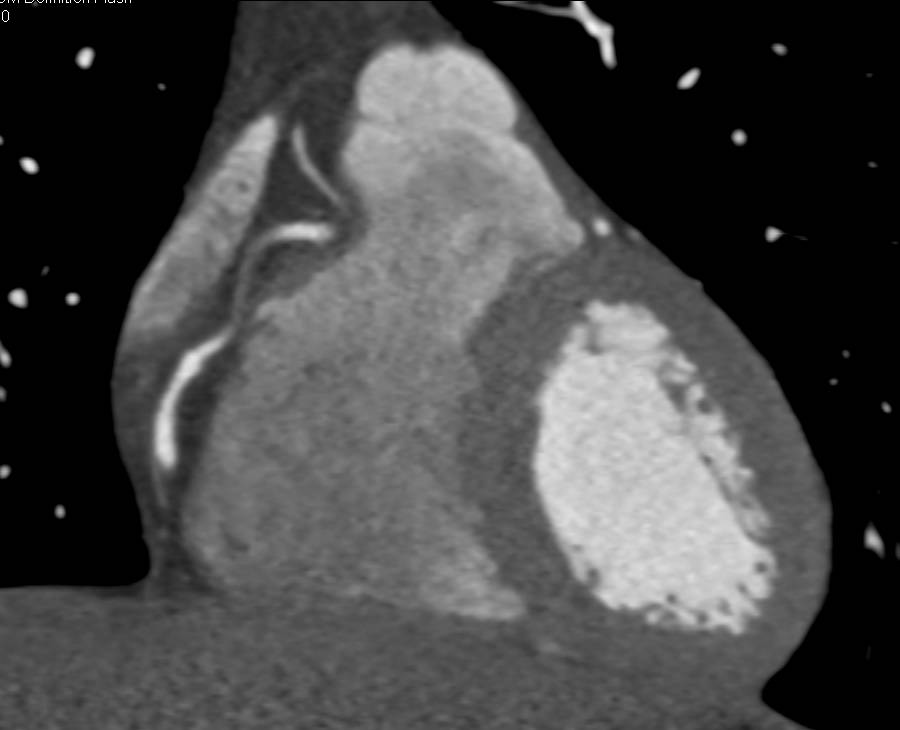 CCTA: Normal 3D Mapping of Coronary Arteries - CTisus CT Scan