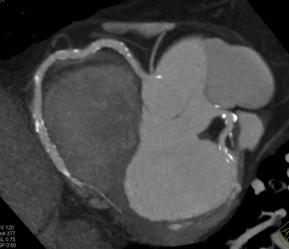 CCTA: Left Anterior Descending Coronary Artery (LAD) Stent and Multivessel Coronary Artery Disease - CTisus CT Scan