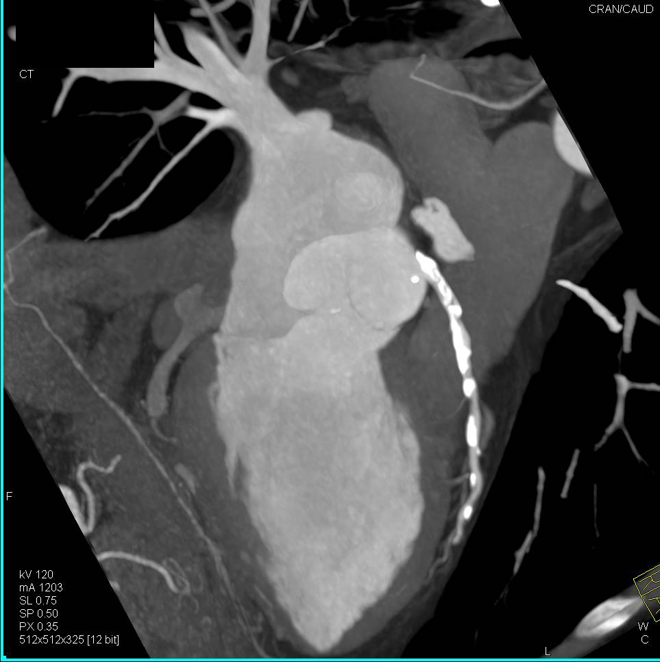 CCTA: Extensive Calcified Plaque in the Left Anterior Descending Coronary Artery (LAD) - CTisus CT Scan