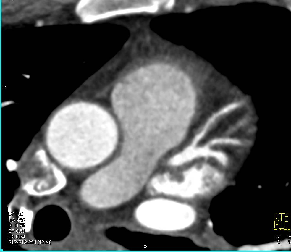 CCTA: Left Anterior Descending Coronary Artery (LAD) Plaque Without Critical Stenosis - CTisus CT Scan