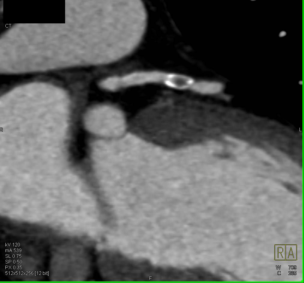 CCTA: Coronary Artery Disease with Near Occlusion of Left Anterior Descending Coronary Artery (LAD) - CTisus CT Scan