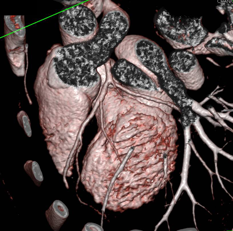 CCTA: Normal Left Anterior Descending Coronary Artery (LAD) - CTisus CT Scan