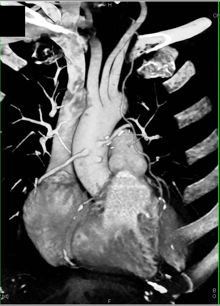 CCTA: Coronary Artery Bypasses with LIMA and 3 Venous Grafts , Two of Which are Still Patent - CTisus CT Scan