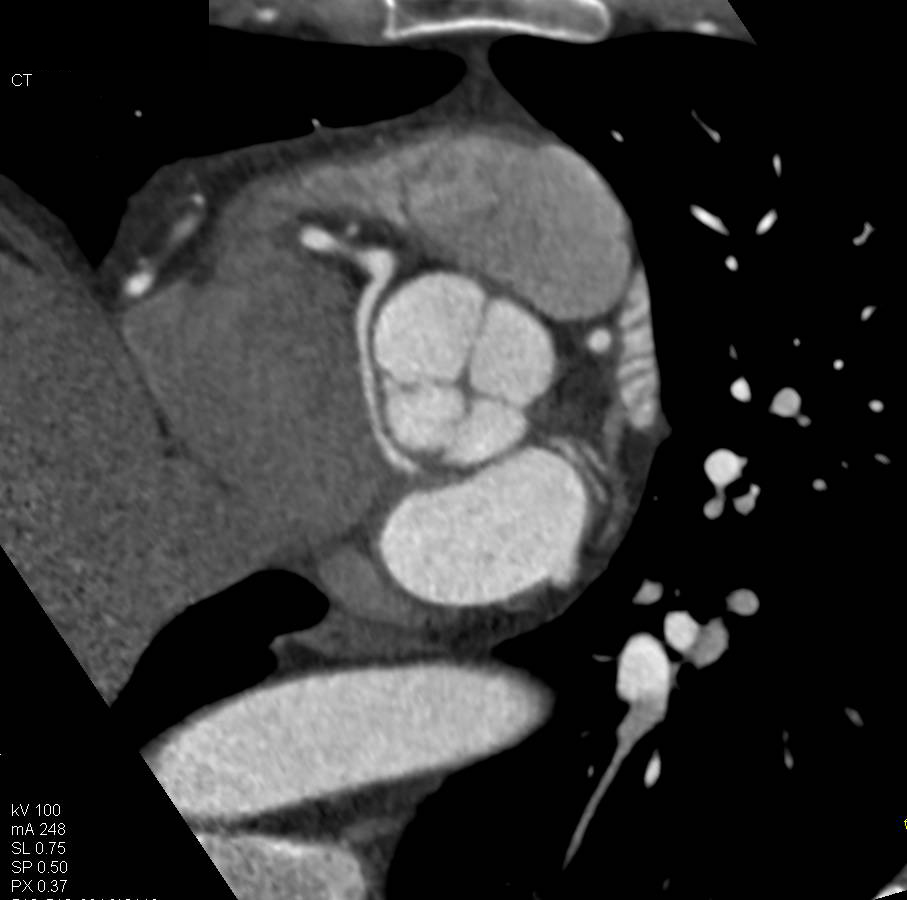 CCTA: Anomalous Circumflex Coronary Artery Arising off the Right Coronary Artery in a Non Malignant Configuration in Multiple Views - CTisus CT Scan