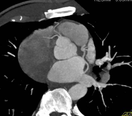 CCTA: Normal Coronary Anatomy - CTisus CT Scan